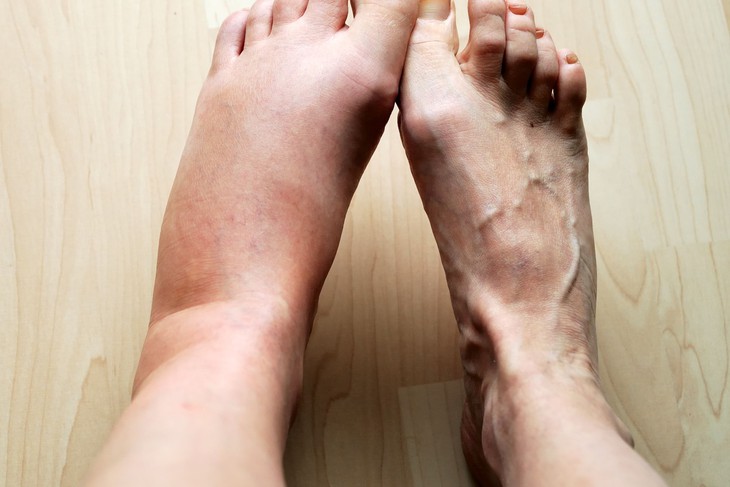 6 Dấu Hiệu Cảnh Báo Thận Đang Suy Yếu Cần Thăm Khám Sớm